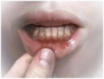 canker-sore