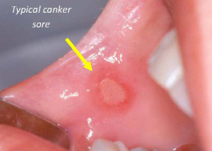 Typical Canker Sore